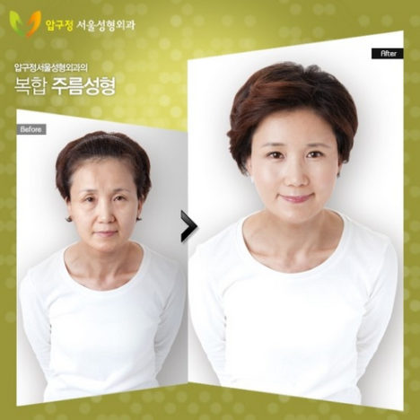 korean-plastic-surgery-before-and-after-12