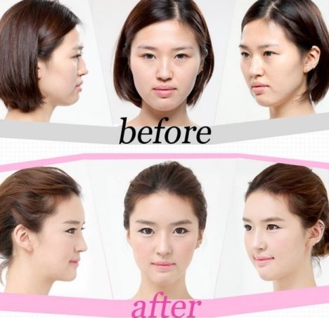 korean-plastic-surgery-before-and-after-14