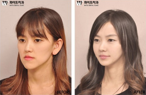 korean-plastic-surgery-before-and-after-2