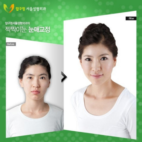 korean-plastic-surgery-before-and-after-22