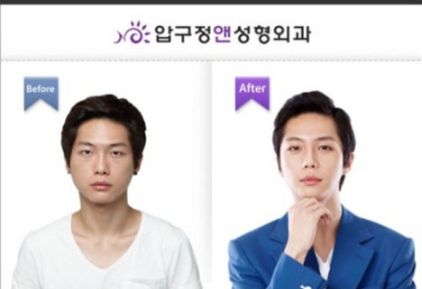 korean-plastic-surgery-before-and-after-27