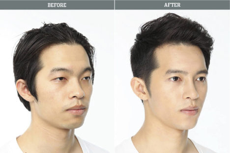 korean-plastic-surgery-before-and-after-31
