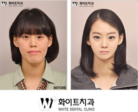 korean-plastic-surgery-before-and-after-4