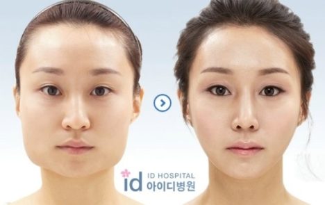 korean-plastic-surgery-before-and-after-17