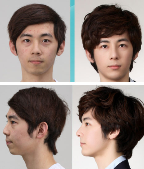 korean-plastic-surgery-before-and-after-26